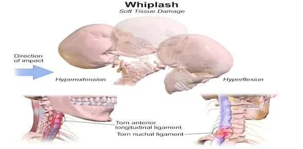 Soft Tissue Injuries After A Car Accident