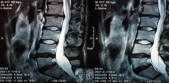Car Accident Trauma Caused Herniated Disc?