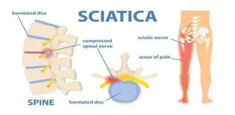 Diagram illustrating sciatic nerve pain: a herniated disc presses on the spinal nerve, leading to low back pain and discomfort along the sciatic pathway, shown on a spine and leg illustration.