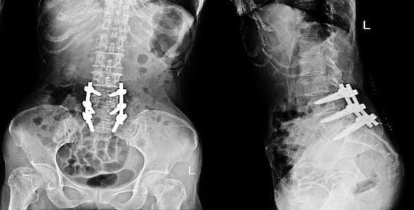 Did You Suffer A Spinal Cord Injury? Read This Before You Hire A Lawyer